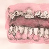 Meth Teeth