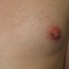Nipple
