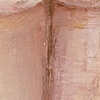 Bruise VIII