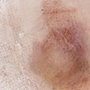 Bruise I