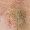 Bruise V