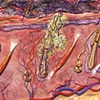 Canine Dermatophytosis