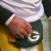 Broken hand