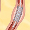 Coronary Artery Stent