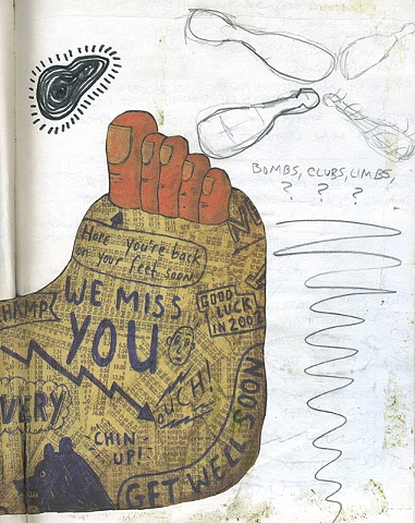 club foot