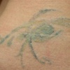 Before, some laser removal to be covered up.