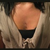 Cleavage Microdermals