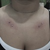 Multiple Chest Microdermals