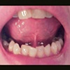 Tongue Web Piercing