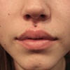 Philtrum Piercing (Medusa)