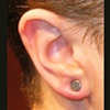 Dermal Punched Lobes
