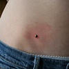 Hip Dermal Anchor