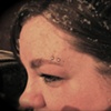 Eyebrow Micro Dermals