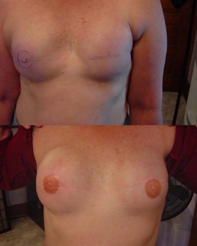 Mastectomy