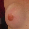 Mastectomy