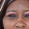 Forehead Dermals
