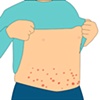 Rash