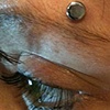 two month(ish) old surface anchor above the eyebrow.  Still has the starter disc on it.