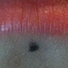 Two really healed labrets (snakebites).  The mark for the piercing we are about to do.