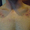 Four fresh dermal anchors on the chest.