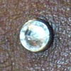 Two Healed dermal anchors on the neck/hairline. (zoomed in view)
