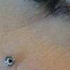 super healed dermal anchor on the cheek with freshly changed bezel set cz.  VERY NICE!