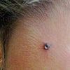 fresh dermal anchor on the side of the neck with bezel set cz