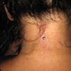 fresh dermal anchor on the nape of the neck
