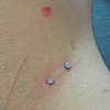 fresh surface piercing on the hip