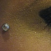healed dermal anchor with cz (right side)