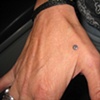 healed dermal anchor on hand