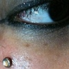 Fresh dermal anchor on the right upper cheek.  I let her start with the cz because I know her to be a careful/good healer.