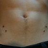 Four surface anchors on the hips.  The two lower down are a week old, and the two higher up are freshly done.