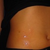 Two fresh dermal anchors with cz's on the hip.  One more to come