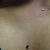 One super healed surface piercing in the middle of the chest.  One fresh surface piercing, and the marks for the other one.