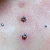 Two very old dermal anchors with flower cz's in the middle.  A third one above (vertically) had to come out.  Four fresh 16g dermal anchors with cz's. 