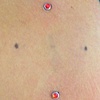 Two fresh dermal anchors on left shoulder blade area.  Two more to come.