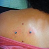 Two healed dermal anchors (up and down), and two fresh dermal anchors (left and right) on the left shoulder blade