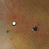 Two fresh dermal anchors on the right side of the chest. (zoomed in view)