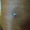 SUPER HEALED six+ month old dermal anchor on the outer calf. (zoomed in view)