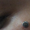 fresh dermal anchor on the anti-eyebrow area