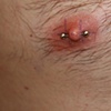 Male Nipple
