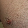 Male nipples
