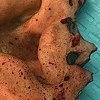 Severed Ear