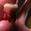 Wisdom Tooth