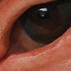 Orbital Prosthesis