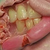 Mouth Prosthesis