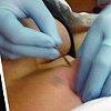 Side Breast Process