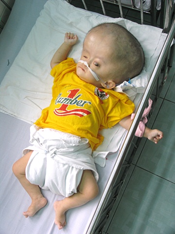 Go Vap Orphanage on the outskirts of Ho Chi Minh City houses some 300 children, many carrying pathologies associated with Agent Orange. Swelling of the head and brain is a common trait in children exposed to dioxin.