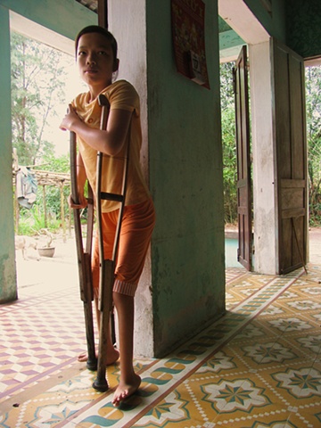 A young girl rest on her crutches, Danang